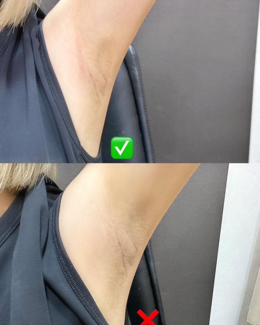 愛爾麗診所東寧店，網紅Zhen禎體驗【冰晶鑽雷射除毛】大方高舉我的雙手!