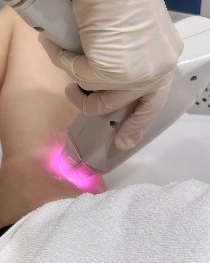 愛爾麗診所東寧店，網紅Zhen禎體驗【冰晶鑽雷射除毛】大方高舉我的雙手!